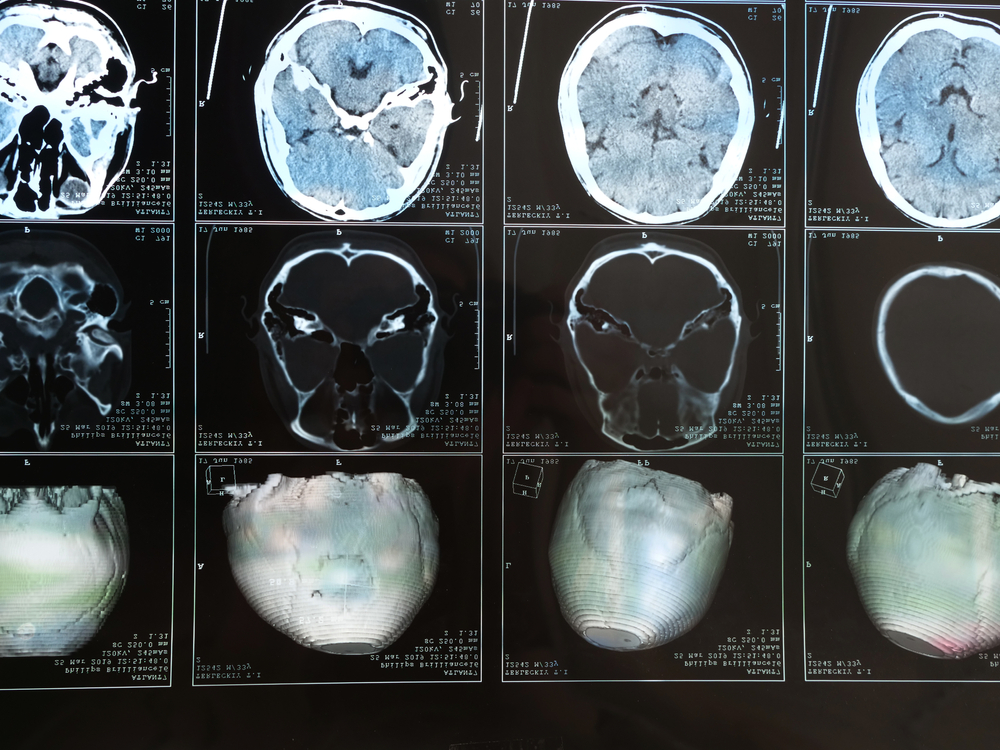 Florida Traumatic Brain Injury lawyer